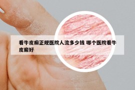 看牛皮癣正规医院人流多少钱 哪个医院看牛皮廨好