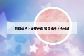 银屑病手上变硬疙瘩 银屑病手上会长吗