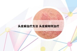 头皮癣治疗方法 头皮癣如何治疗