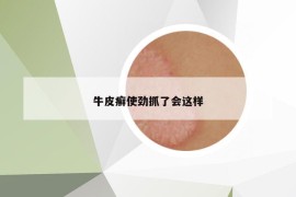 牛皮癣使劲抓了会这样