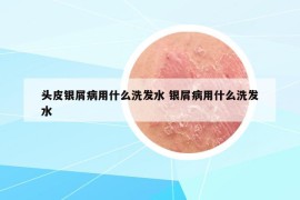 头皮银屑病用什么洗发水 银屑病用什么洗发水