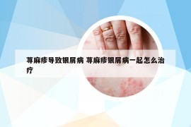 荨麻疹导致银屑病 荨麻疹银屑病一起怎么治疗