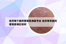 南京哪个医院看银屑病最专业 南京哪家医院看银屑病比较好