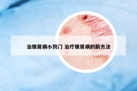 治银屑病小窍门 治疗银屑病的新方法