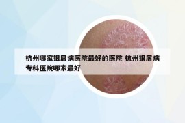 杭州哪家银屑病医院最好的医院 杭州银屑病专科医院哪家最好