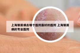 上海银屑病去哪个医院最好的医院 上海银屑病的专业医院