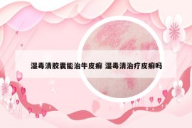 湿毒清胶囊能治牛皮癣 湿毒清治疗皮癣吗