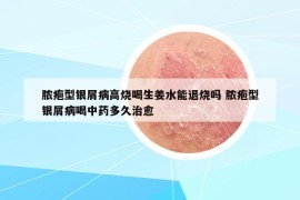 脓疱型银屑病高烧喝生姜水能退烧吗 脓疱型银屑病喝中药多久治愈