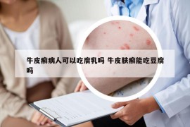 牛皮癣病人可以吃腐乳吗 牛皮肤癣能吃豆腐吗