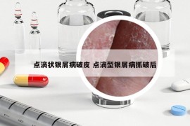 点滴状银屑病破皮 点滴型银屑病抓破后