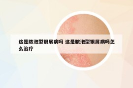 这是脓泡型银屑病吗 这是脓泡型银屑病吗怎么治疗