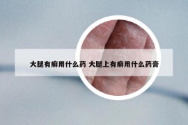 大腿有癣用什么药 大腿上有癣用什么药膏