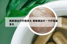 银屑病治疗疗程多久 银屑病治疗一个疗程是多久