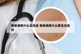 银屑病用什么皂洗澡 银屑病用什么肥皂洗澡好