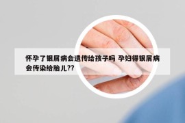 怀孕了银屑病会遗传给孩子吗 孕妇得银屑病会传染给胎儿??