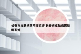 长春市皮肤病医院哪家好 长春市皮肤病医院哪家好