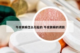 牛皮肤癣怎么引起的 牛皮肤癣的诱因