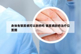 身体有银屑病可以刮痧吗 银屑病刮痧治疗位置图