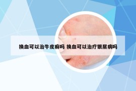 换血可以治牛皮癣吗 换血可以治疗银屑病吗