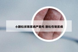 小颗粒状银屑病严重吗 颗粒性银屑病