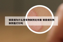 银屑病为什么用生物制剂无效果 银屑病生物制剂是打针吗