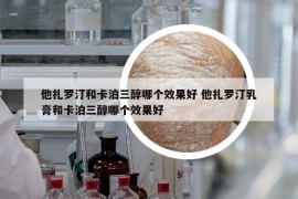 他扎罗汀和卡泊三醇哪个效果好 他扎罗汀乳膏和卡泊三醇哪个效果好