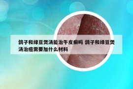 鸽子和绿豆煲汤能治牛皮癣吗 鸽子和绿豆煲汤治痘需要加什么材料