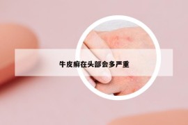 牛皮癣在头部会多严重