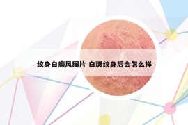 纹身白癜风图片 白斑纹身后会怎么样