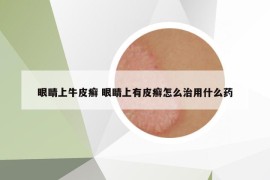 眼睛上牛皮癣 眼睛上有皮癣怎么治用什么药