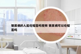 银屑病的人能吃榴莲吗视频 银屑病可以吃榴莲吗