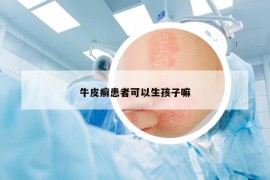 牛皮癣患者可以生孩子嘛