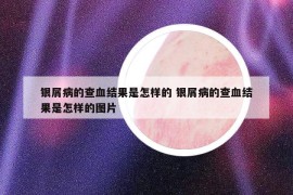 银屑病的查血结果是怎样的 银屑病的查血结果是怎样的图片