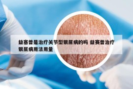 益塞普是治疗关节型银屑病的吗 益赛普治疗银屑病用法用量