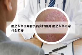 脸上长白斑用什么药膏好照片 脸上长白班涂什么药好