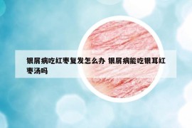 银屑病吃红枣复发怎么办 银屑病能吃银耳红枣汤吗