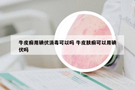 牛皮癣用碘伏消毒可以吗 牛皮肤癣可以用碘伏吗