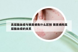 高尿酸血症与银屑病有什么区别 银屑病和高尿酸血症的关系