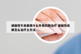 顽固性午皮癣用什么外用药物治疗 顽固性皮癣怎么治疗土方法