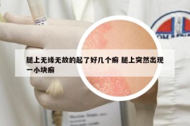 腿上无缘无故的起了好几个癣 腿上突然出现一小块癣