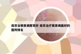 南京治银屑病那家好 南京治疗银屑病最好的医院排名