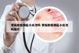 掌跖脓疱病起小水泡吗 掌跖脓疱病起小水泡吗图片