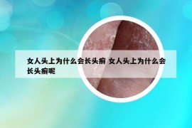 女人头上为什么会长头癣 女人头上为什么会长头癣呢