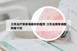 江苏治疗银屑病最好的医院 江苏治银屑病医院哪个好