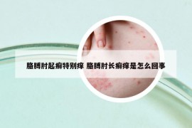 胳膊肘起癣特别痒 胳膊肘长癣痒是怎么回事