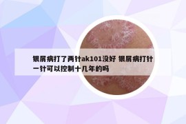 银屑病打了两针ak101没好 银屑病打针一针可以控制十几年的吗