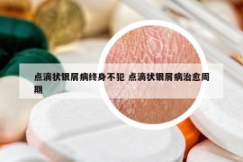 点滴状银屑病终身不犯 点滴状银屑病治愈周期