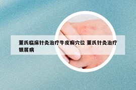 董氏临床针灸治疗牛皮癣穴位 董氏针灸治疗银屑病