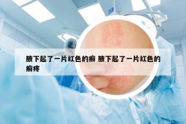 腋下起了一片红色的癣 腋下起了一片红色的癣疼