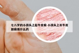 七八岁的小孩头上起牛皮癣 小孩头上长牛皮肤癣用什么药